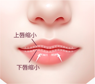 唇部缝合示意图