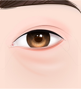Before Surgery