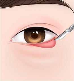 Minimal Incision