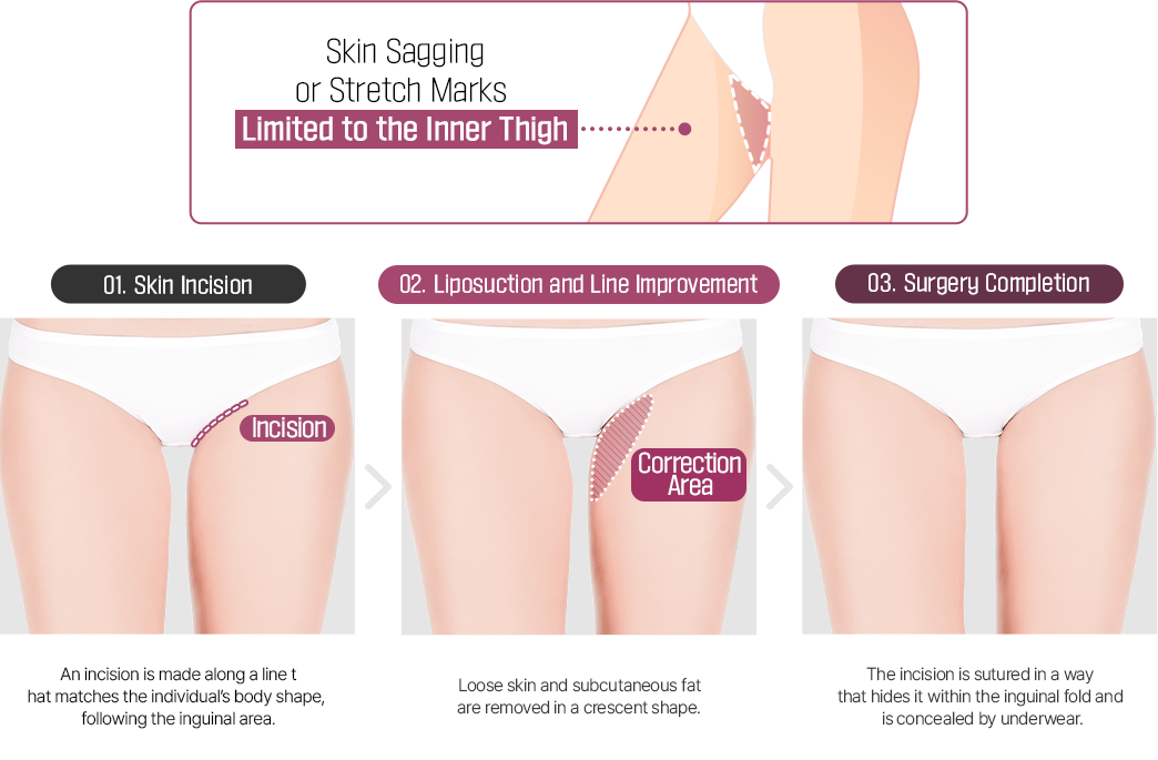 Mini Thighplasty